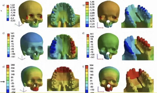 Los modelos pueden predecir el esfuerzo del cráneo, de los músculos y de los dientes con tratamientos de labio fisurado y el paladar hendido/Diego Garzón Alvarado