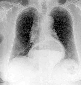 Radiografía de los pulmones (FOTO: Diego Grez).