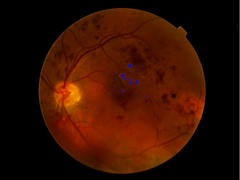 El software de procesado detecta y marca posibles lesiones (exudados duros) asociadas a la retinopatía diabética que podrían derivar en la ceguera del paciente (FOTO: Grupo de Ingeniería Biomédica).