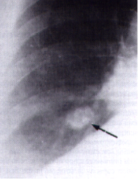Nódulo pulmonar causado por 'Dirofilaria immitis' en una persona. Imagen: Fernando Simón.