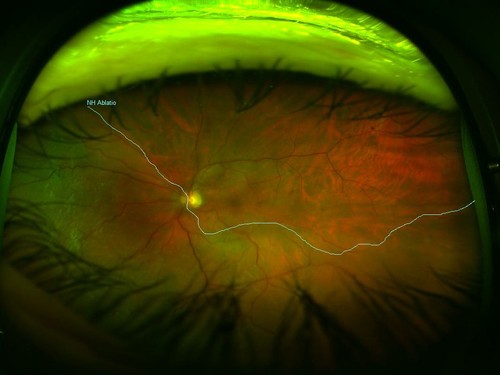 Desprendimiento de retina/Amaris5