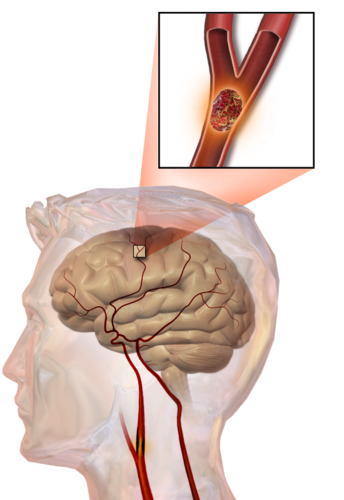 Accidente cerebrovascular. Autor: Blausen Medical Communications, Inc.