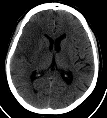 Un cerebro con ictus isquémico visto a través de una tomografía computarizada/Hospital Clínico Universitario de Valladolid