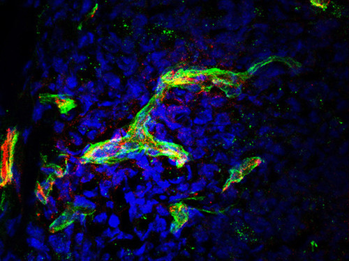 Células tumorales (azul), vasos (rojo) y proteína (verde) que permite que los linfocitos lleguen al tumor./CNB-CSIC.