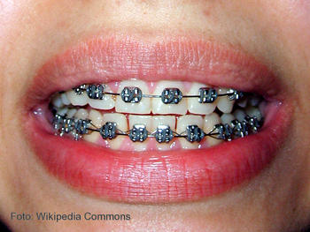 Tratamiento de ortodoncia.