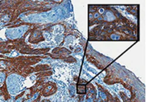 Imagen de un tumor con expresión heterogénea de la EGFR. Las partes marrones indican la zona de expresión de la proteína (imagen: A. C. Camargo Cancer Center)