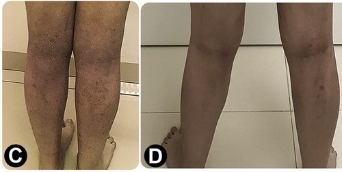 Un paciente de 15 años con lesiones en las piernas causadas por dermatitis atópica (C) y al cabo 18 meses de tratamiento (D), con una mejoría acentuada de los síntomas/Sarah Sella Langer et al./Journal of Allergy and Clinical Immunology