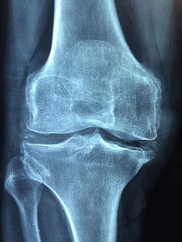 Radiografía de rodilla/UN
