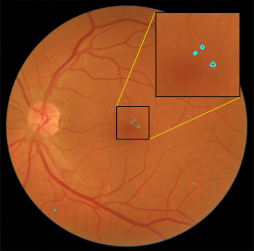 Imagen de fondo de ojo en la que el sistema ha detectado lesiones rojas, precursoras de retinopatía diabética/R. Romero