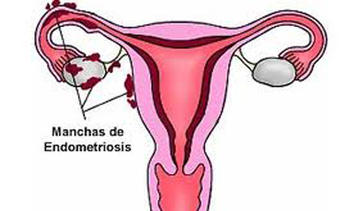 Endometriosis (FOTO: Infouniversidades).