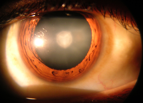Catarata en ojo humano/Rakesh Ahuja, MD