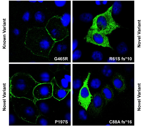 Localización subcelular de algunas variantes de OCT1 expresadas en células de hepatocarcinoma y detectadas por inmunofluorescencia. Foto: HEVEFARM.