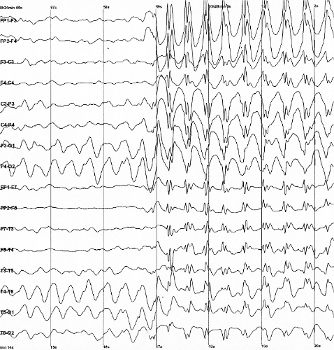 Electroencefalografía (3 Hz) de un niño al momento de una crisis epiléptica<7<der <lange