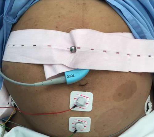 Dispositivo que ayuda a reducir riesgos en los embarazos prolongados. Foto: UPV.