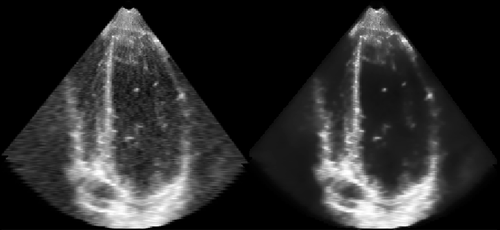 Ecocardiografía. A la izquierda la original, a la derecha filtrada se puede ver cómo SELENE preserva el tejido miocárdico mientras reduce el speckle en las cavidades cardíacas. FOTO: G. Vegas.