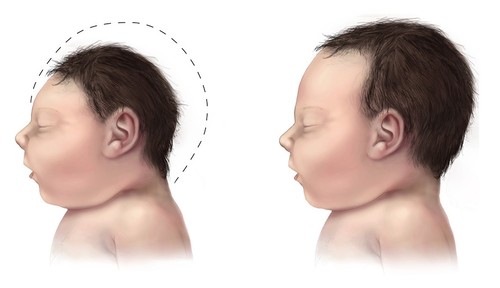Alteraciones cerebrales causadas por el virus Zika en bebés/Wikiwand