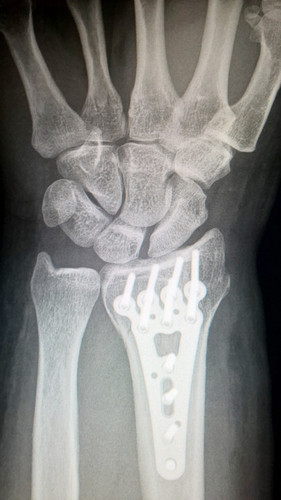 Osteogénesis por distracción ósea. Imagen: F. Descubre.