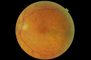 Imagen de un paciente con retinopatía diabética (FOTO: IOBA).