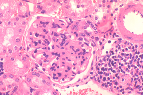 Imagen representativa de glomerulonefritis autoinmune característica de ratones con lupus eritematoso sistémico. Imagen: CSIC.