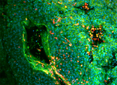 Imagen de células del sistema inmune dentro del melanoma, el cáncer de piel más agresivo.