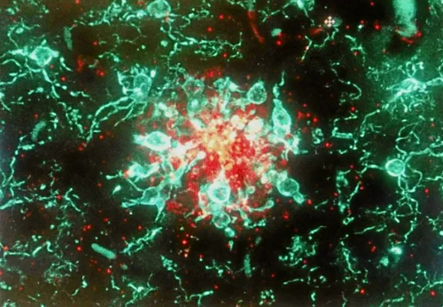 Placa de beta amiloide (rojo) y de microglía (verde)./UGR.